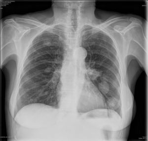 Radiografía de tórax AP y lateral.