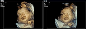 Imágenes ecográficas 4D donde se aprecia la macroglosia fetal.