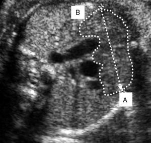 Corte transverso del tórax del feto entre el esternón y los grandes vasos del corazón donde se observa el diámetro transversal (a) y los bordes del timo (b), el cual aparece como una estructura oval y homogénea en el mediastino anterior, compuesto por 2 lóbulos conectados.