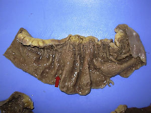 Pared intestinal con granulomas, la mucosa está ulcerada y muestra cambios secundarios a la isquemia.