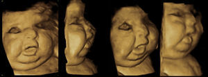 Reconstrucción tridimensional de la cara del feto con micrognatia, aspecto edematoso o hidrópico. Cuello corto, frente prominente, de cara ancha y amplia.