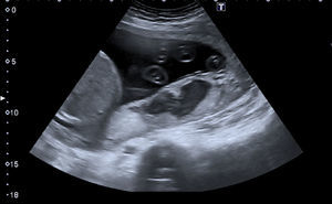 Absceso placentario visualizado por ecografía abdominal.
