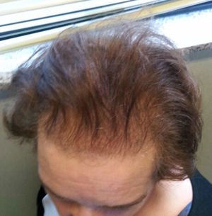 Alopecia androgénica.