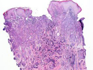 Tumor que conecta y ulcera la epidermis.