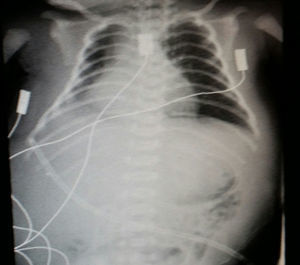 Radiografías de tórax-abdomen: desplazamiento de asas intestinales por líquido abdominal.