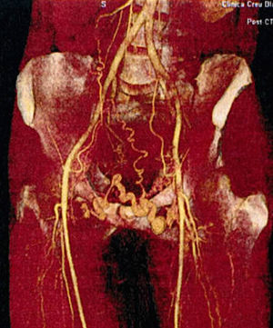 Circulación colateral, signo de Palmaz, posible hipoplasia/agenesia de vena cava inferior.