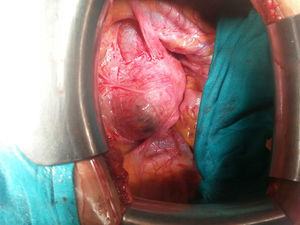 Imagen de laparotomía exploradora. Estructura anómala en región uterina izquierda.
