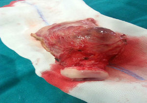 Pieza quirúrgica que muestra que dicha formación se encuentra sobre la cicatriz de la cesárea anterior.