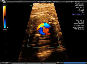 Anillo vascular.