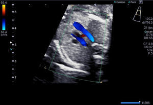 Arco aórtico derecho. Doppler. Variante especular.
