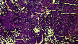 Hiperplasia endometrial asociada al hallazgo de metaplasma ósea.