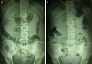 A) La radiografía simple de abdomen en decúbito muestra gran dilatación de asas de intestino. B) En la radiografía simple de abdomen en bipedestación son evidentes los niveles hidroaéreos en cuadrante inferior derecho.