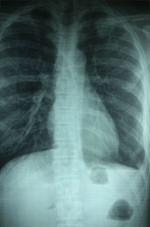 La radiografía del tórax sin presencia de lesiones pulmonares evidentes.