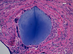 Imagen microscópica de inflamación granulomatosa con reacción gigantocelular tipo a cuerpo extraño (×200).
