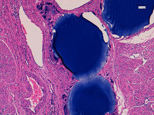 Imagen macroscópica del caso 2. Leiomioma necrosado y presencia de partículas de embolización.