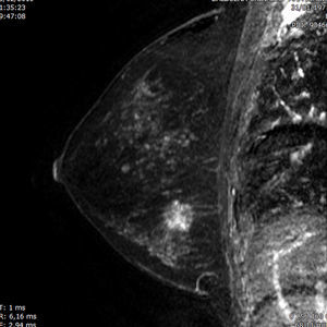 Secuencia sagital T1 con supresión grasa tras administración de contraste con reconstrucción proyección de máxima intensidad en mujer de 38 años de edad, BRCA2+ y mamografías con un patrón de alta densidad. La RM demuestra una masa espiculada con realce interno heterogéneo, un hallazgo representativo de carcinoma ductal invasivo.