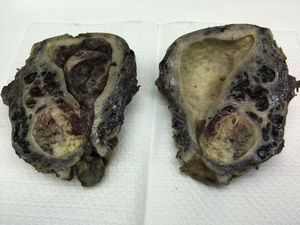 Útero. Imagen macroscópica del útero, donde se aprecia una lesión polipoide y un nódulo miometrial con frecuentes émbolos vasculares.