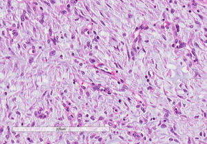 Imagen microscópica: el área celular se compone las células ovoides o en forma de huso con un escaso citoplasma eosinófilo. Existen numerosos los pequeños vasos de paredes finas que se asemejan arterias espirales (HE 20x).