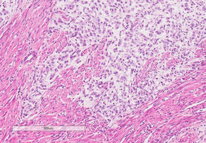 En el área mixoide, las células tumorales fusiformes infiltran el miometrio.