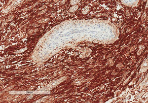 Estudio inmunohistoquímico: células tumorales con positividad intensa para CD10.