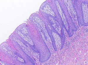 Estudio histopatológico (tinción con hematoxilina). Epidermis con hiperplasia de las crestas interpapilares, paraqueratosis con polimorfonucleares intracórneos y presencia de conglomerados de queratocitos necróticos. Papilas dérmicas profundas con abundantes macrófagos espumosos.