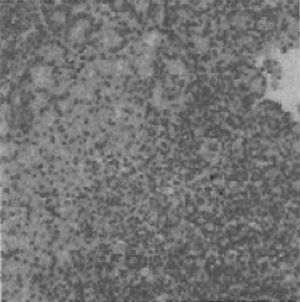 Úlcera de Lipschütz. Biopsia de lesión vulvar donde se objetiva infiltrado inflamatorio, sin presencia de microorganismos ni malignidad.