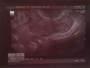 Ecografía transvaginal en la que se visualiza una masa tubular en forma de salchicha de 76,9×23,6mm.