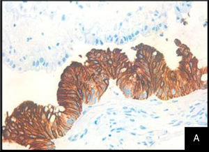 Foto a 400X con inmunotinción para citoqueratina 7 (CK7) que tiñe el epitelio normal de la trompa uterina.