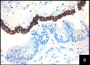 Foto de la misma zona con inmunotinción para citoqueratina 20 (CK20), que tiñe el epitelio de tipo intestinal (y demuestra el origen colónico).
