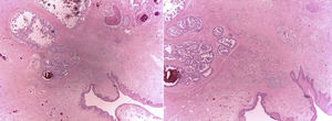 Cortes histológicos de la neoplasia con tinción hematoxilina-eosina.