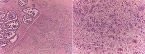 Cortes histológicos de la neoplasia con tinción hematoxilina-eosina, a mayor aumento.