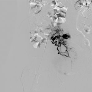 Angiografía: ovillo vascular.