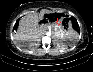 Corte axial de tomografía computarizada de aneurisma esplénico roto en la fase arterial.