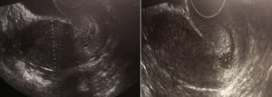 Imágenes ecográficas realizadas en el control posterior al tratamiento médico con metotrexato. Se observa un endometrio lineal, con una imagen milimétrica a nivel cervical, compatible con hematoma secundario a la reabsorción de la gestación ectópica.