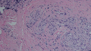 Granuloma epitelioide constituido por histiocitos elongados y ovoideos con presencia de linfocitos, sobre fondo limpio sin necrosis.