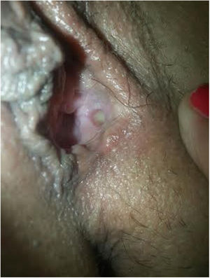 Antes de la reconstrucción: obsérvese la ausencia del labio menor izquierdo (caído por necrosis secundaria a hematoma) y restos de la cápsula de la glándula Bartholin izquierda.