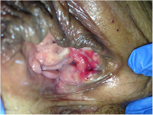 Distorsión anatómica, oquedad.