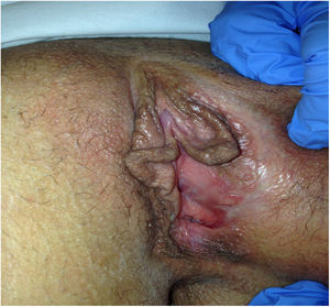 Pérdida de tejido vulvar en el labio menor izquierdo.