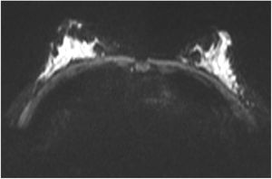 RMN con múltiples quistes de contenido heterogéneo y realce de sus paredes (BIRADS 3) compatible con papilomatosis juvenil múltiple.