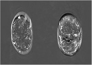 RMN con múltiples imágenes bilaterales sugestivas de papilomas.