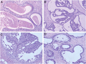 Características anatomopatológicas típicas observadas en la papilomatosis juvenil11. (A) Múltiples conductos dilatados que contienen secreciones espesas y células espumosas (aumento, × 100); (B) proliferación epitelial papilar intraquística (aumento, × 40); (C) metaplasia apocrina (aumento, × 100), y (D) conductos dilatados y quistes (aumento, × 40).