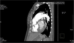 Angiotomografía computada de tórax contrastada. Corte transversal: se observa incremento en la luz de la arteria pulmonar.