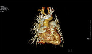 Reconstrucción en tercera dimensión de la angiotomografía. El tamaño de la arteria pulmonar se puede comparar con el de la arteria aorta.