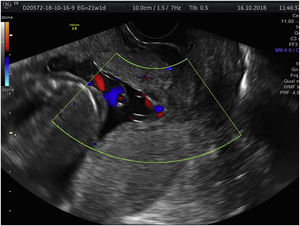 Vasos fetales por delante de la presentación fetal en orificio cervical interno.