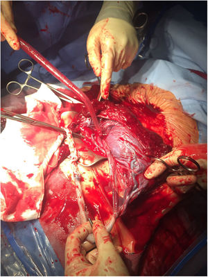 Vasos fetales desprotegidos de placenta en el segmento uterino inferior, durante la intervención quirúrgica.