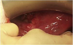 Fotografía que evidencia el defecto (de unos 3cm) a nivel del ligamento ancho izquierdo tras liberación del asa de intestino delgado incarcerada.