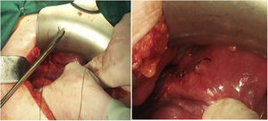 Fotografías en las que se puede advertir la sutura (con hilo reabsorbible lento) del defecto existente a nivel del ligamento ancho izquierdo y el resultado final previo a la finalización de la intervención.