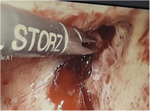 Detalle de la lesión donde se aprecia la infiltración peritoneal.