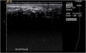 Ecografía de mama derecha en la que se aprecia área retroareolar con muy escasa transmisión del ultrasonido.