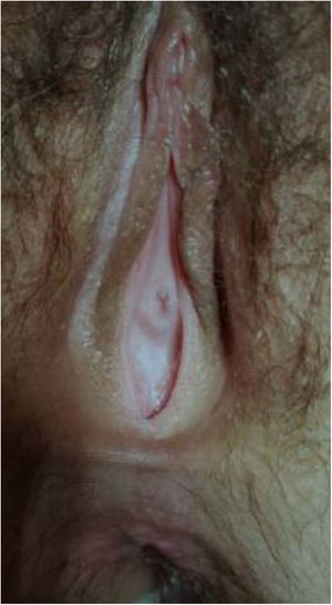 Imagen perineal en la que se observan genitales externos femeninos normales con ausencia de orificio vaginal, meato uretral y ano normoposicionados.